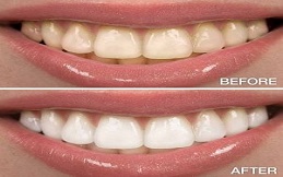 Teeth-Whitening-in-Islamabad-Before-and-After