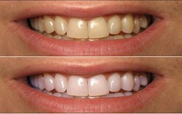 Teeth-Whitening-in-Islamabad-Rawalpindi-Before-and-After-