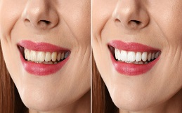 Teeth Whitening in Islamabad