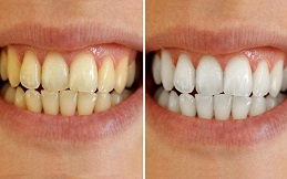 Teeth Whitening