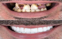 Teeth support Guard before and after in Islamabad