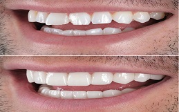 Teeth support Guard before and after