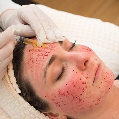 Vampire Facial in Islamabad