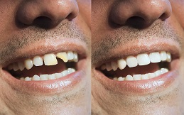 Veneers cost in Islamabad