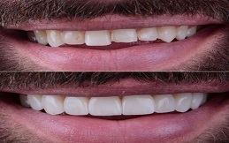 Veneers in Islamabad