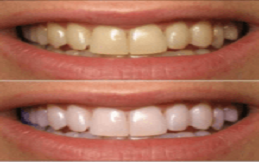 dental veneers islamabad