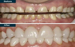 dental-veneers