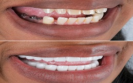 mouth guards in Islamabad