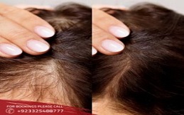 prp-before-after-results-