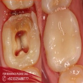 root canal treatment in Islamabad 