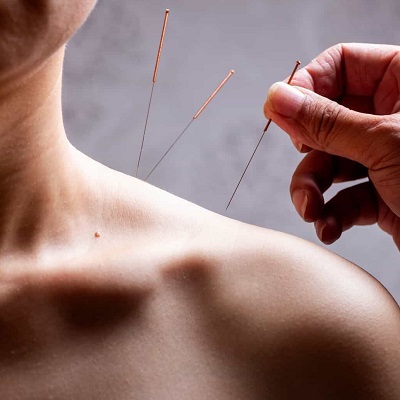Acupuncture treatment in Islamabad