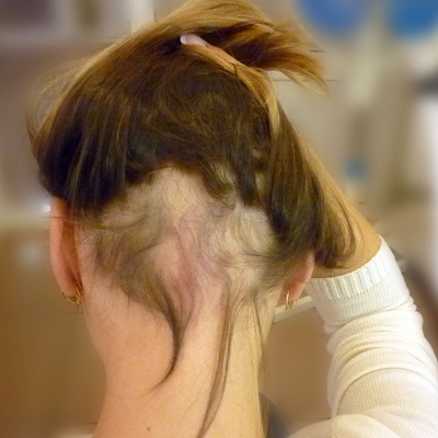 Alopecia Aerata Cost in Islamabad