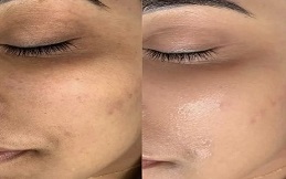 Best HydraFacial in Islamabad,Pakistan