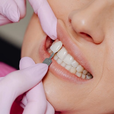 Composite Veneers in Islamabad