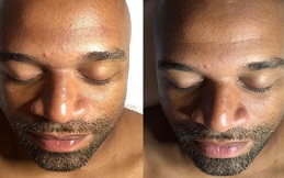 HydraFacial result in Islamabad