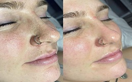Hydrafacial treatment in Islamabad