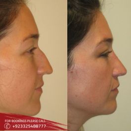 Rhinoplasty before & after in Islamabad