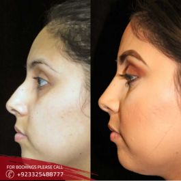 Rhinoplasty cost in Islamabad