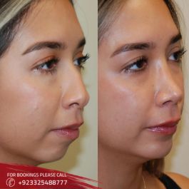 Rhinoplasty in Islamabad