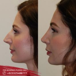 Rhinoplasty result in Islamabad