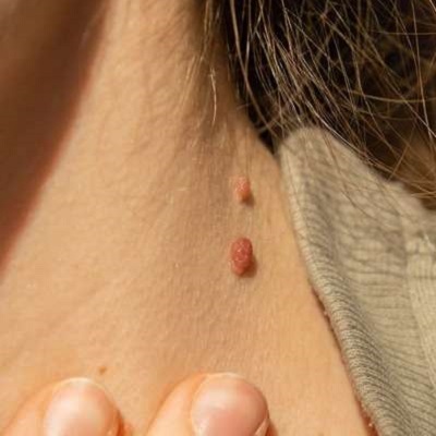 Skin Lesion Removal Cost in Islamabad