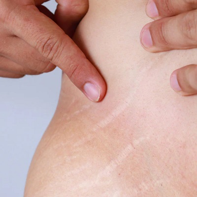 Stretch Marks Removal Cost in Islamabad