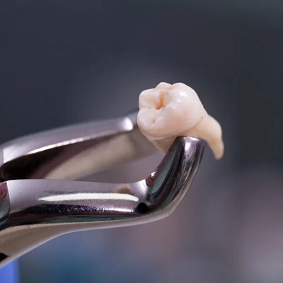 Tooth Extraction Cost in Islamabad