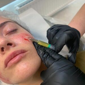 Vampire Facial Cost in Islamabad