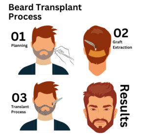 Beard Hair Transplant
