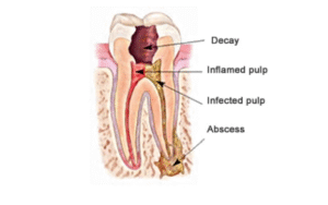 Root canal treatment