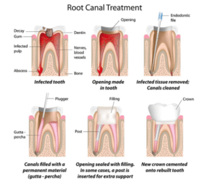 Root Canal Treatment in Islamabad
