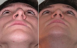 Alarplasty before and after in Islamabad