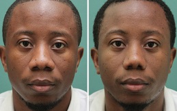 Alarplasty before and after