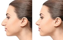 Alarplasty-in-Islamabad-and-Rawalpindi-beofre-after