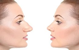 Alarplasty-in-Islamabad-and-Rawalpindi-pakistan-before-after