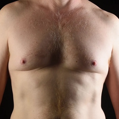 Gynecomastia in Islamabad