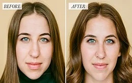 before-after-Alarplasty-in-Islamabad-and-Rawalpindi-1