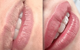Best Lip Tinting before and after in Islamabad