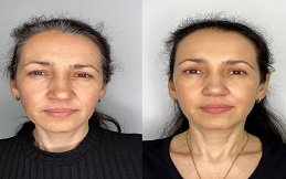 Morpheus 8 before and after in Islamabad