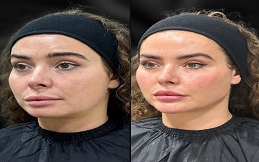 Morpheus 8 result in Islamabad