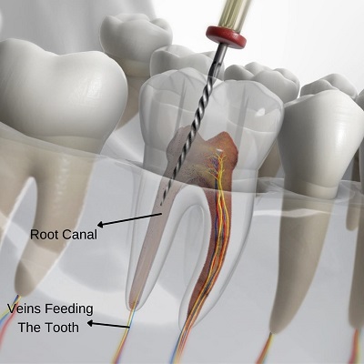Root Canal Treatment in Islamabad