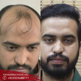 Hair Transplant cost in Islamabad