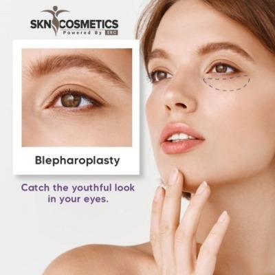 Eyelid Surgery- Blepharoplasty in Islamabad
