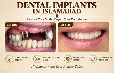 Dental Implants in Islamabad