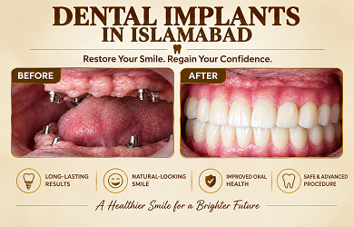 Dental Implants in Islamabad