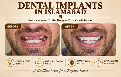 Dental Implants in Islamabad