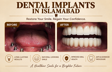 Dental Implants in Islamabad